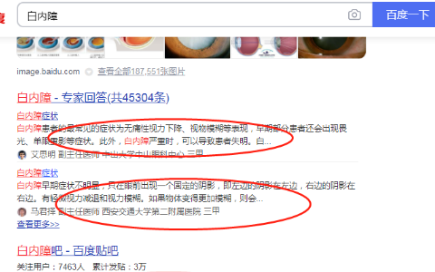 百度搜索白内障的界面